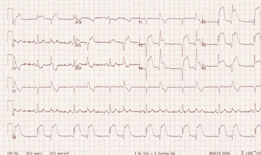 Tracciato elettrocardiografico di infartuato<p />