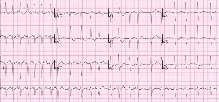 Esempio di ecg cardiaco