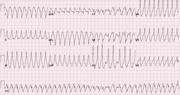 Fibrillazione atriale