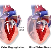 Raffigurazione della valvolva mitrale