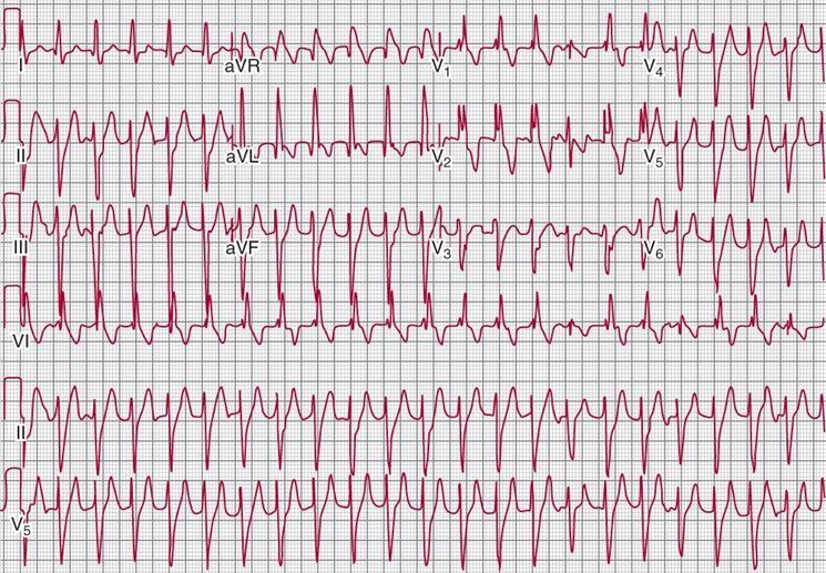 Battito cardiaco irregolare