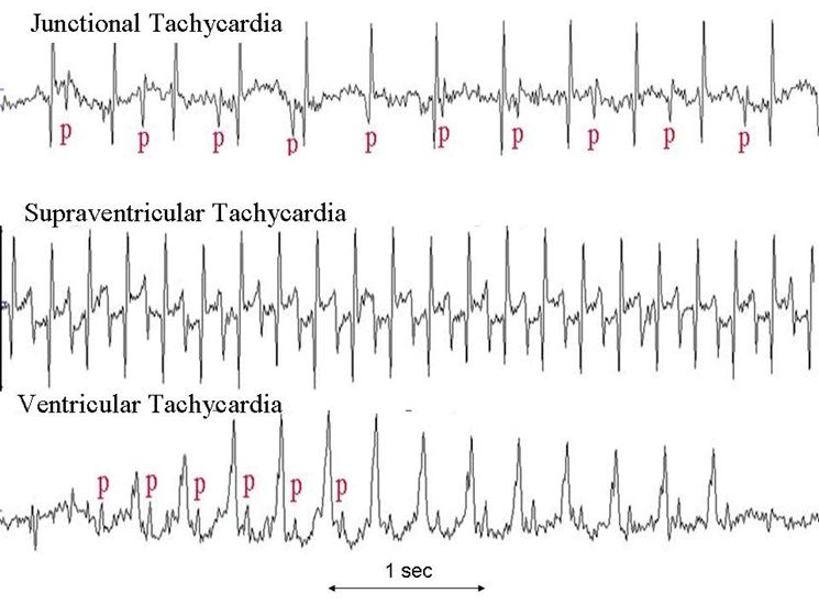 Tachicardia ventricolare
