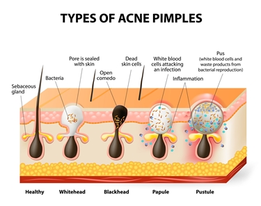 Tipi di foruncoli dell'acne