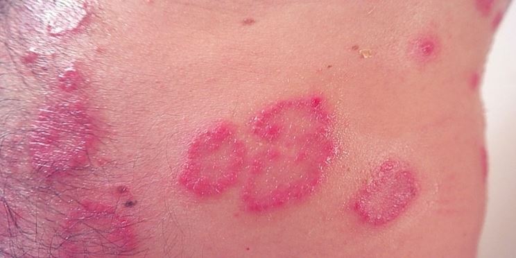 Eczema da dermatite seborroica