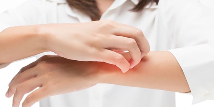 Eczema atopico in et adulta