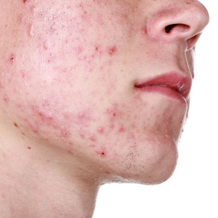 Volto colpito da acne