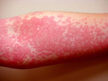 Orticaria.