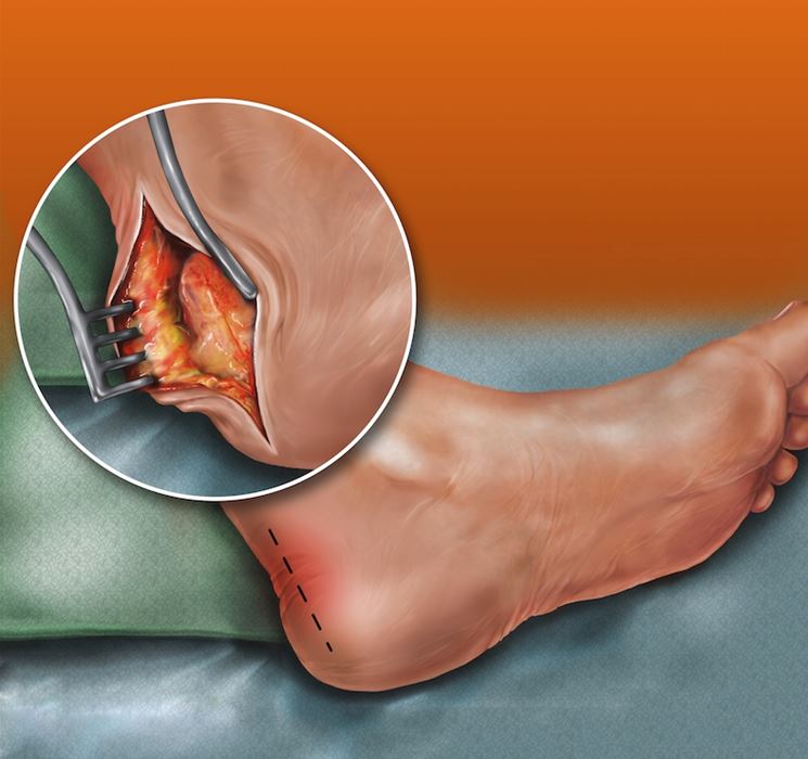 Lesione del tendine d'achille