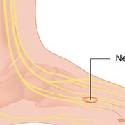 Piede neuroma morton