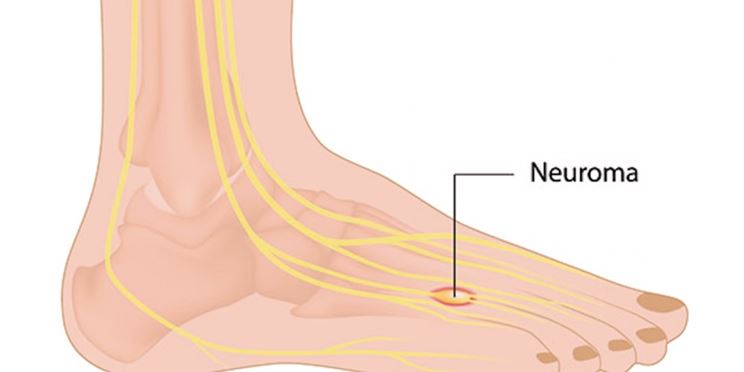 Piede neuroma morton