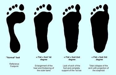 Impronta normale e di piedi piatti