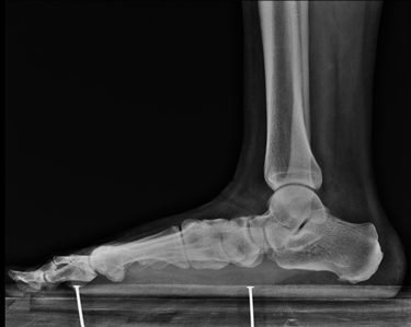 Radiografia di piede piatto