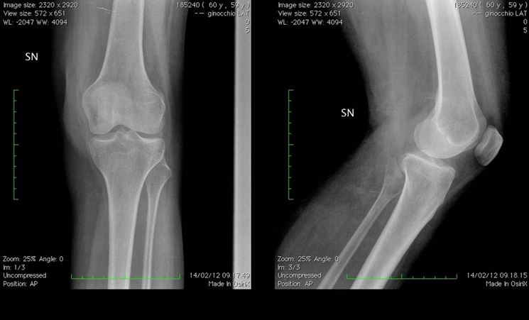 Radiografia ginocchio