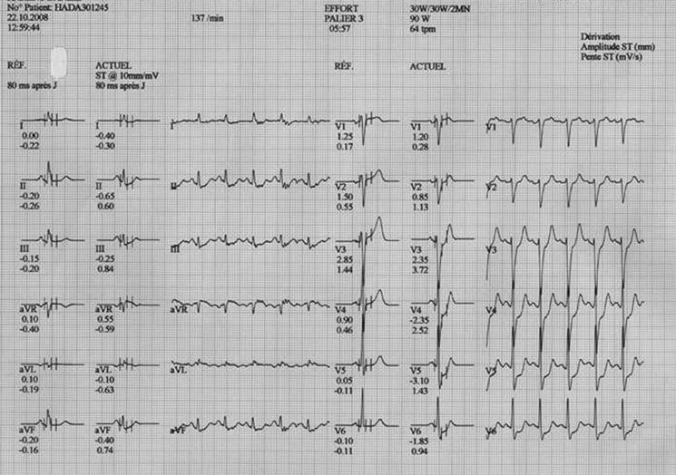 Esempio grafico ECG