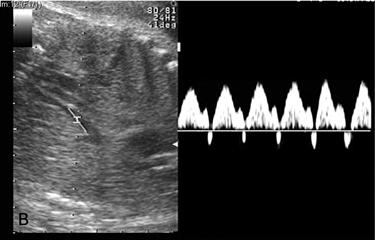 Flussimetria della vena cava inferiore