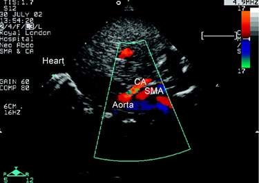 Flussimetria dell'arteria mesenterica superiore