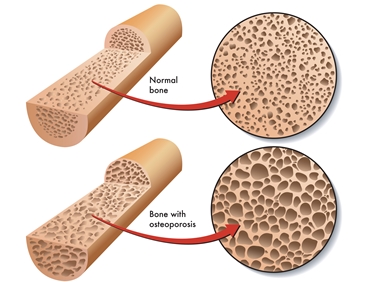 Confronto tra osso sano e afflitto da osteoporosi