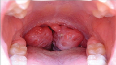 Infiammazione a carico delle tonsille