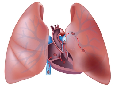 embolo polmonare