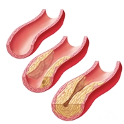 placca aterosclerotica in accrescimento