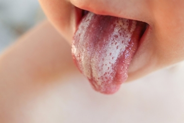 Micosi orale pediatrica