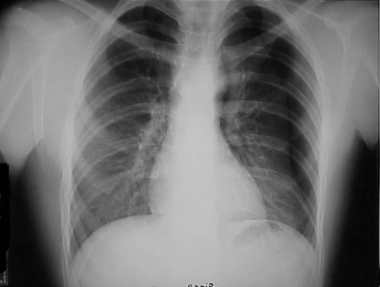 Radiografia di una contusione polmonare