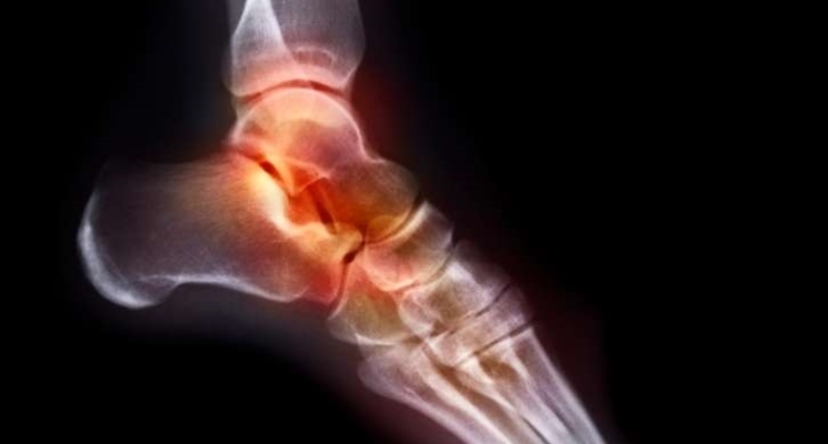 radiografia piede per frattura da stress