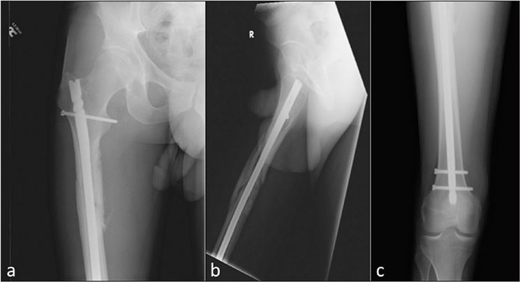 Radiografia femore rotto