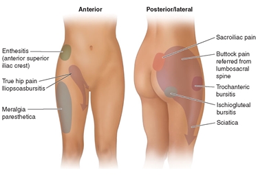 Differenti dolori all'anca