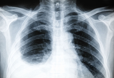 Lastra radiografica di pleurite