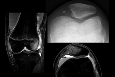 Dislocazione della patella