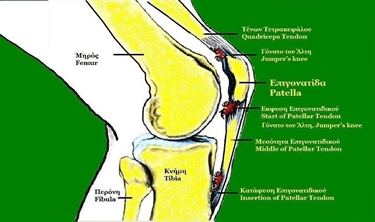 Punti di infiammazione del tendine