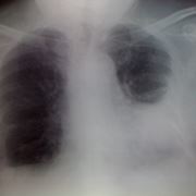 Radiografie per problemi polmonari