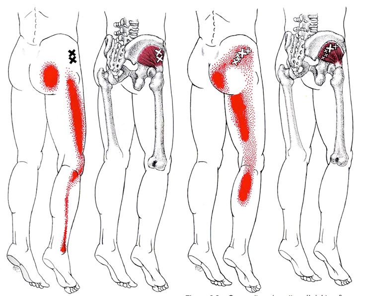 Sindrome del piriforme vs sciatica