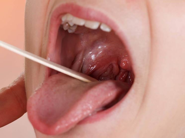 Tonsillite pus