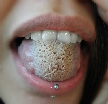 Candida orale diffusasi sulla lingua