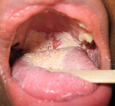 La formazione di una patina bianca sulla bocca  un sintomo di candida orale