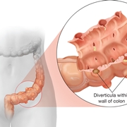 Diverticolosi del sigma sintomi