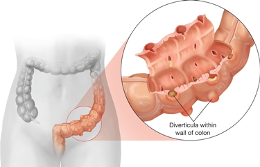 Diverticolosi del sigma sintomi