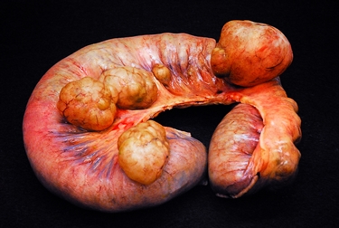 Intestino con grossi diverticoli