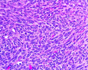 cellule fibroma ovarico<p />