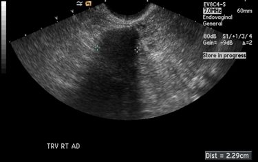 Ecografia di un fibroma dell'ovaio<p />