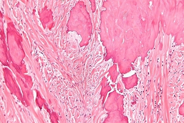 Fibroma ovarico al microscopio<p />