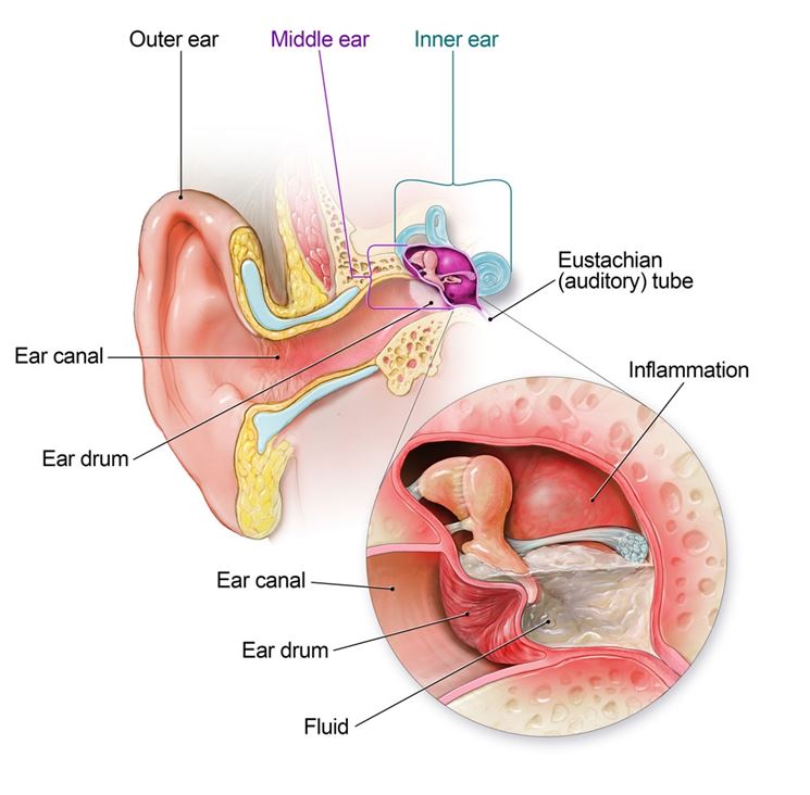 Infiammazione dell'orecchio interno
