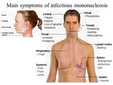 Principali sintomi della mononucleosi infettiva