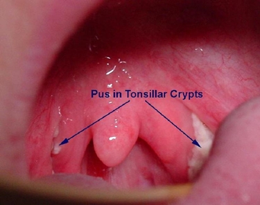 Pus nelle cripte tonsillari.<p />