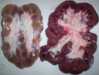 Sezione di un rene con nefrite