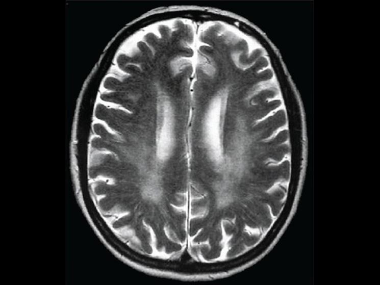 Diagnosticare sclerosi multipla