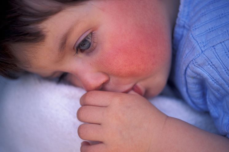 Bambino affetto da scarlattina