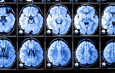 Risonanza magnetica al cervello<p />